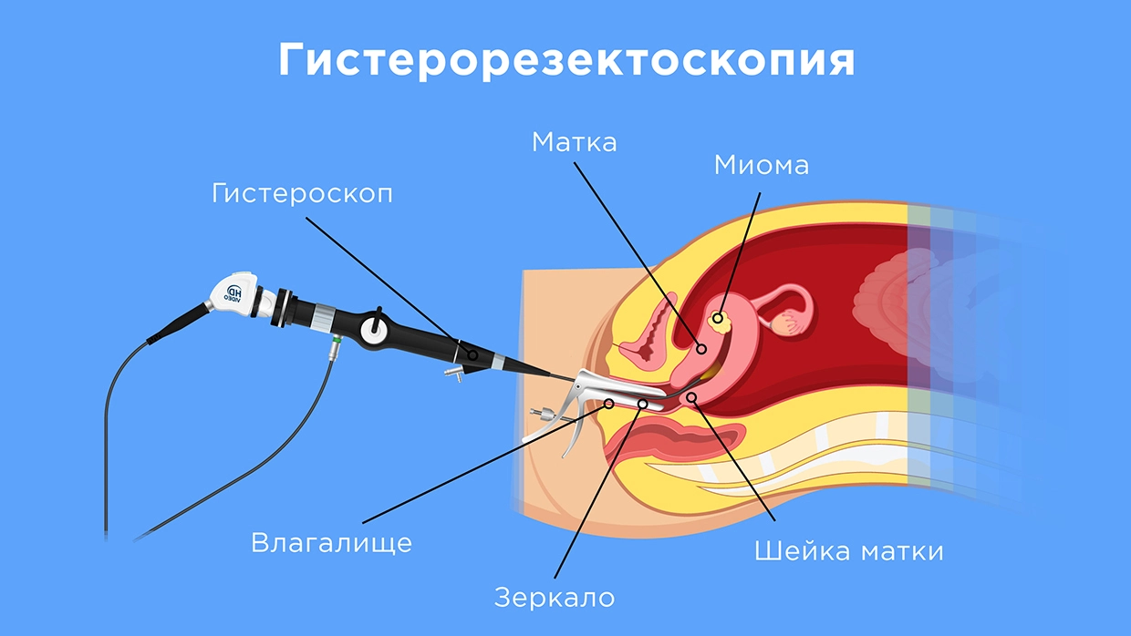 Субмукозная миома матки - методы хирургического лечения